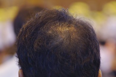 【頭頂部の薄毛は治る！】つむじはげの原因と画期的な最新治療法とは？