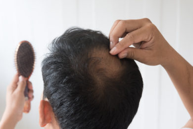 【つむじの薄毛】見分け方や抜け毛の原因、頭頂部の毛髪を回復する治療法について
